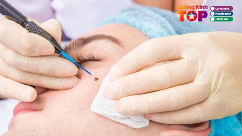 Top-5-dia-chi-xoa-not-ruoi-tai-quang-ninh-uy-tin-khong-dau-quangninhtoplist